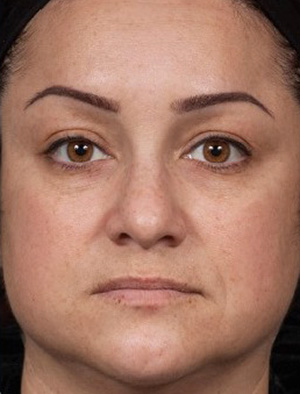 Laser Rejuvenation Before & After Patient #1401