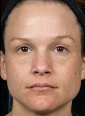 Laser Rejuvenation Before & After Patient #1396