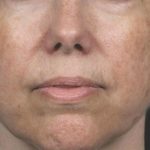 Laser Rejuvenation Before & After Patient #1397
