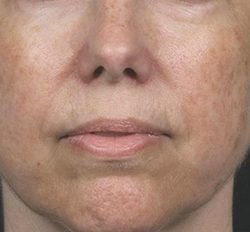 Laser Rejuvenation Before & After Patient #1397