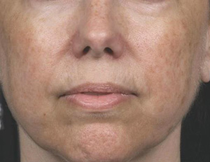 Laser Rejuvenation Before & After Patient #1397