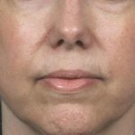 Laser Rejuvenation Before & After Patient #1397