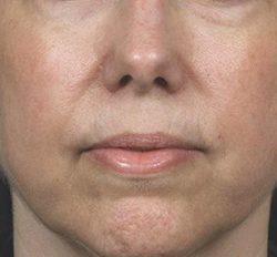 Laser Rejuvenation Before & After Patient #1397