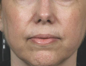 Laser Rejuvenation Before & After Patient #1397