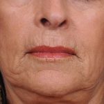 Dermabrasion Before & After Patient #1399