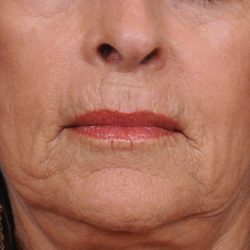 Dermabrasion Before & After Patient #1399