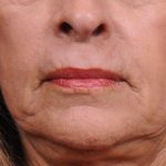 Dermabrasion Before & After Patient #1399