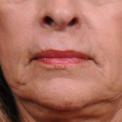 Dermabrasion Before & After Patient #1399