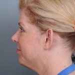 Otoplasty Before & After Patient #710