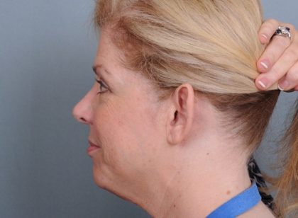 Otoplasty Before & After Patient #710