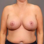 Breast Lift / Mastopexy Before & After Patient #3138