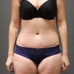 Abdominoplasty Before & After Patient #3186