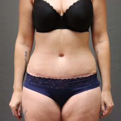 Abdominoplasty Before & After Patient #3186