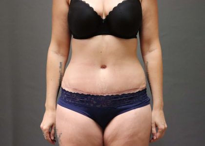 Abdominoplasty Before & After Patient #3186