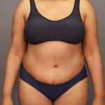 Abdominoplasty Before & After Patient #3157