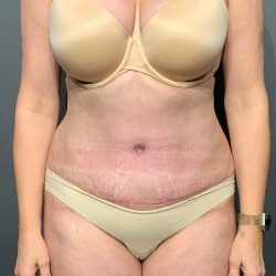 Abdominoplasty Before & After Patient #3188