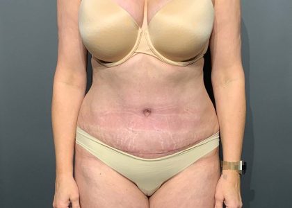Abdominoplasty Before & After Patient #3188