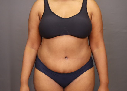 Abdominoplasty Before & After Patient #3157