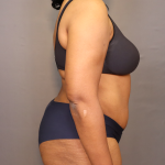 Abdominoplasty Before & After Patient #3157