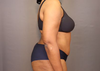 Abdominoplasty Before & After Patient #3157