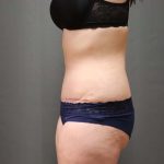 Abdominoplasty Before & After Patient #3186