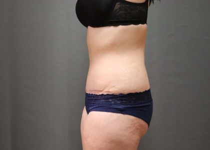 Abdominoplasty Before & After Patient #3186