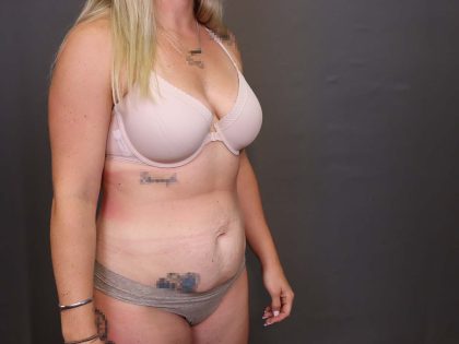 Abdominoplasty Before & After Patient #3178
