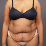 Abdominoplasty Before & After Patient #3157