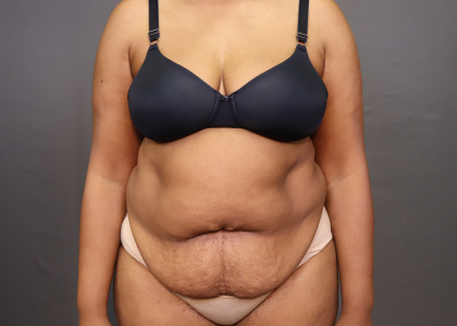 Abdominoplasty Before & After Patient #3157