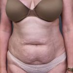 Abdominoplasty Before & After Patient #3188