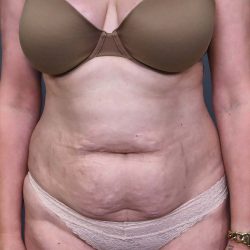 Abdominoplasty Before & After Patient #3188