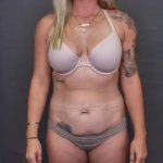Abdominoplasty Before & After Patient #3178