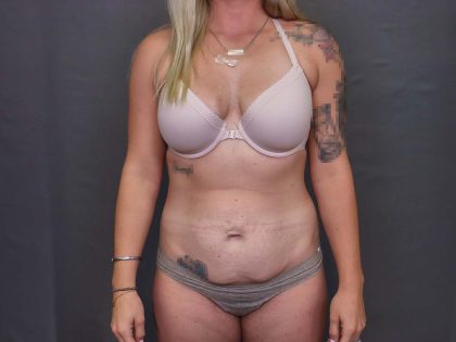 Abdominoplasty Before & After Patient #3178