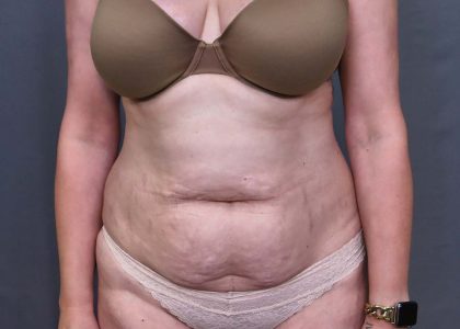 Abdominoplasty Before & After Patient #3188