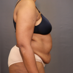 Abdominoplasty Before & After Patient #3157