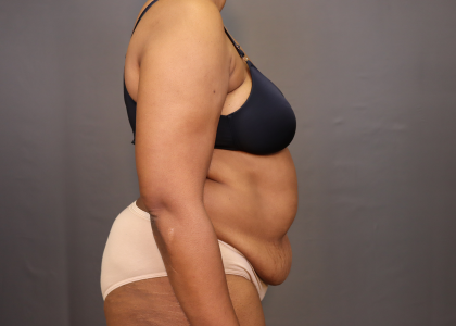 Abdominoplasty Before & After Patient #3157