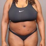 Abdominoplasty Before & After Patient #3177
