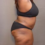 Abdominoplasty Before & After Patient #3177