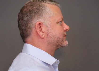 Chin Implants Before & After Patient #3239