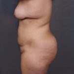 Brazilian Butt Lift Before & After Patient #3236