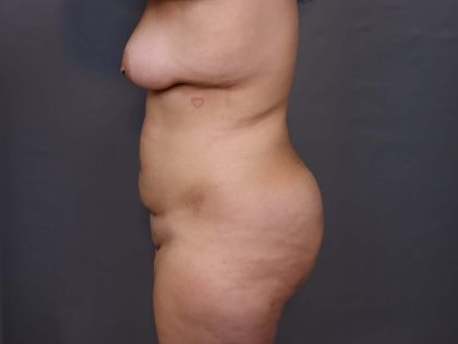 Brazilian Butt Lift Before & After Patient #3236