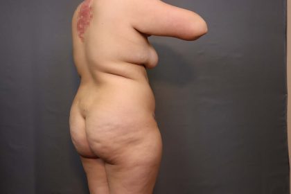 Brazilian Butt Lift Before & After Patient #3236