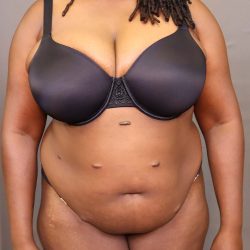 Abdominoplasty Before & After Patient #3177