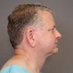Chin Implants Before & After Patient #4367