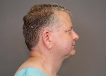 Chin Implants Before & After Patient #3239