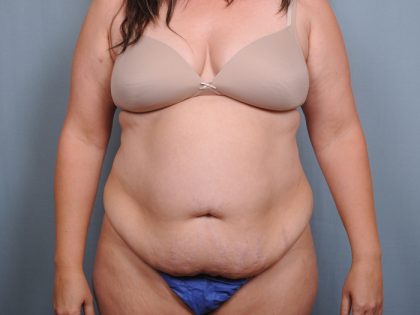 Abdominoplasty Before & After Patient #1470
