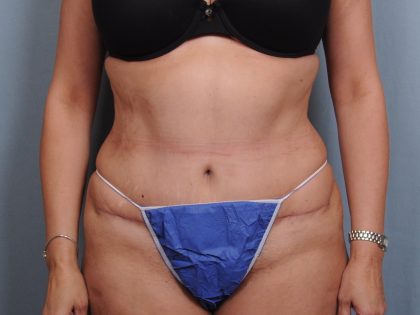 Abdominoplasty Before & After Patient #1461