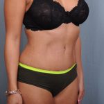 Abdominoplasty Before & After Patient #1405