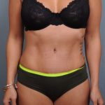 Abdominoplasty Before & After Patient #1405