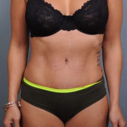 Abdominoplasty Before & After Patient #1405